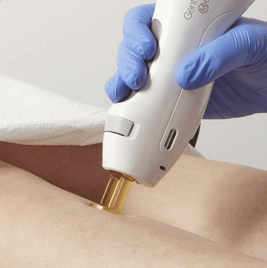 patient-gentle-treatment-leg-veins-1