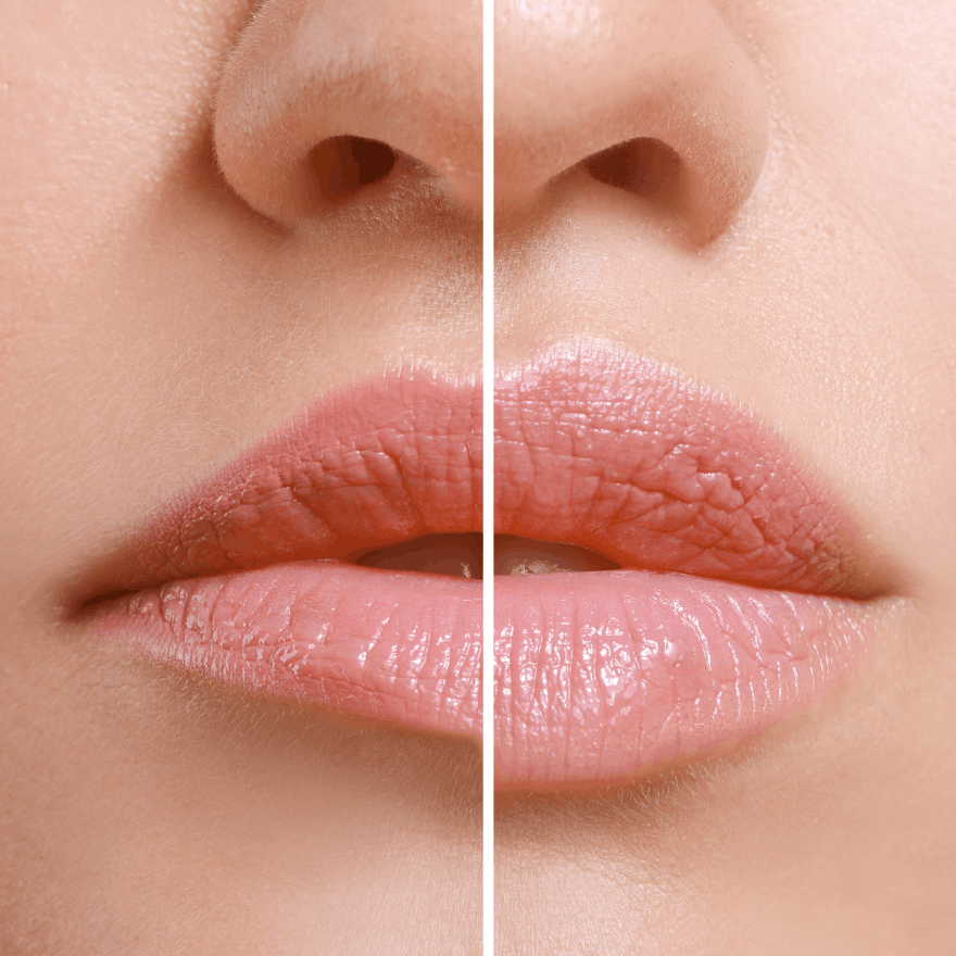 estetske-procedure-usne